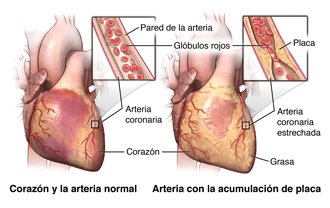 El corazón y las arterias y la acumulación de placa en la pared arterial