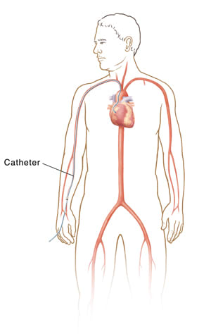 Outline of body showing transradial cardiac catheterization.